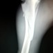 ROTURA PATA TRASERA (TIBIA-PERONE)